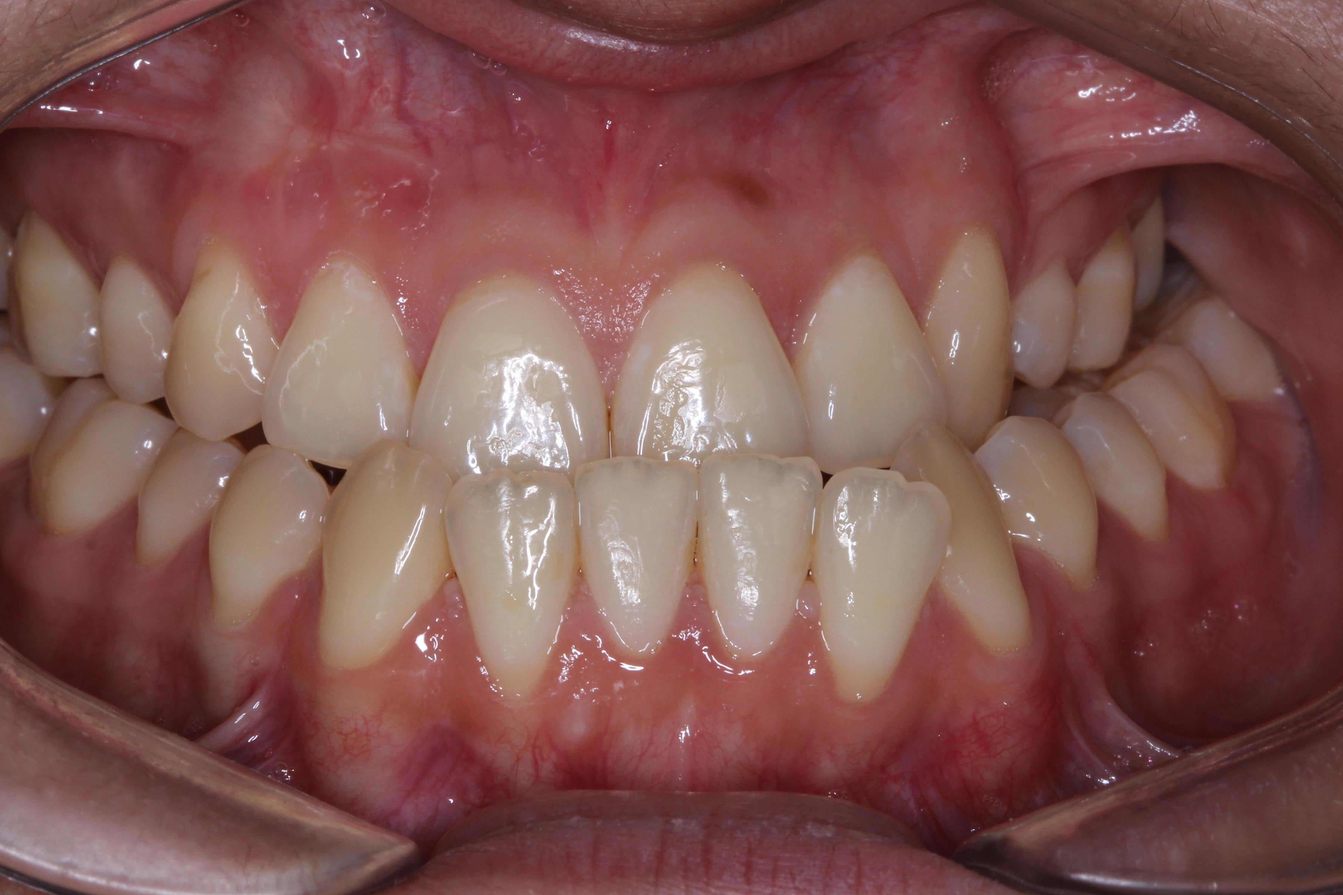 Clase III esqueletal con desviación mandibular antes del tratamiento ortodóncico y cirugía ortognática