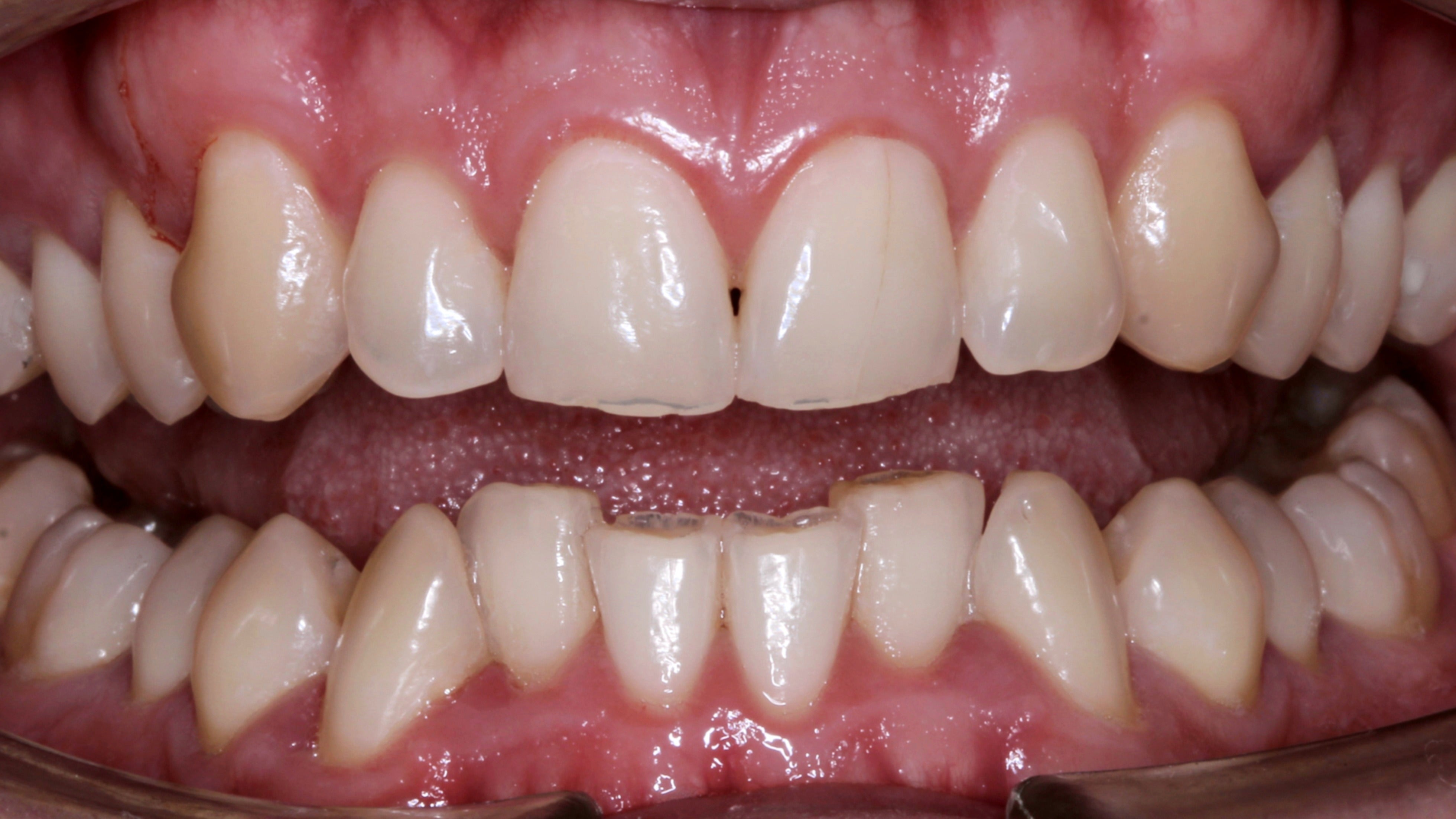 Sobremordida y apiñamiento dental antes del tratamiento con alineadores invisibles